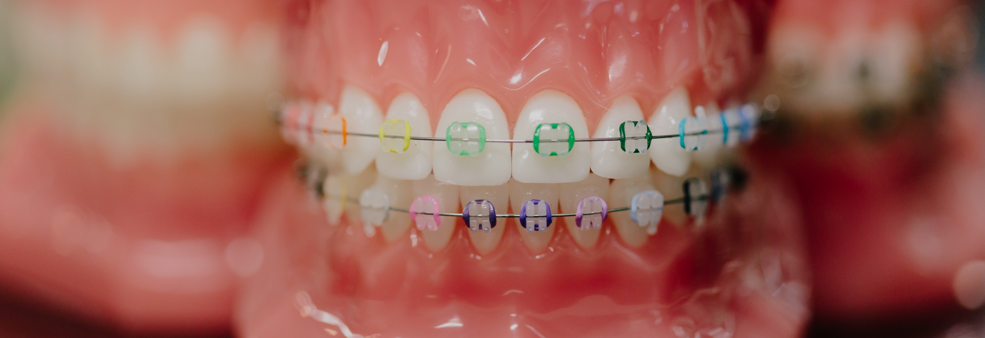 knapp orthodontics can help make getting braces an easy + more comfortable process