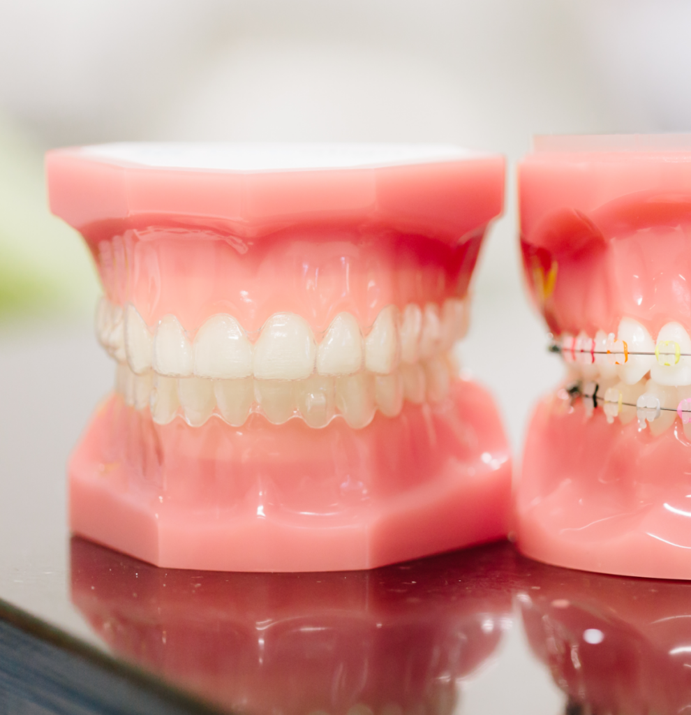 Clear Aligners Knapp Ortho